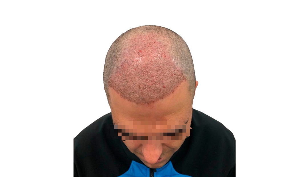 Tipos de alopecia comunes