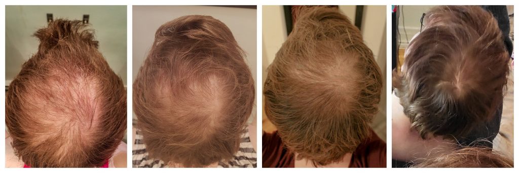 La recuperación del cabello con el uso del finasteride y minoxidil es altamente garantizado a la hora de obtener los resultados deseados. Es importante destacar que, lo ideal es usar ambos medicamentos como tratamientos complementarios 